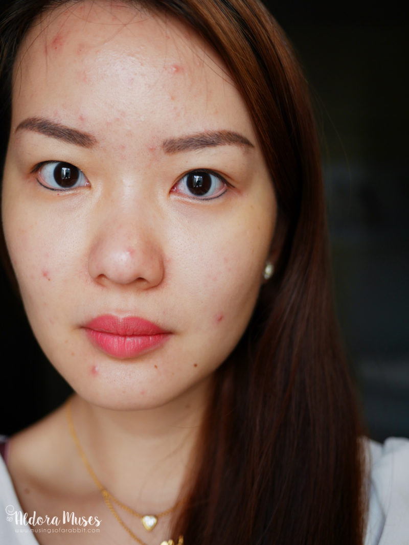 Acne Journey with The Clifford Clinic