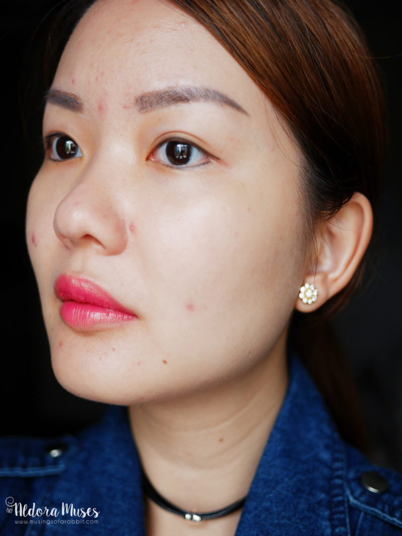 Acne Journey with The Clifford Clinic