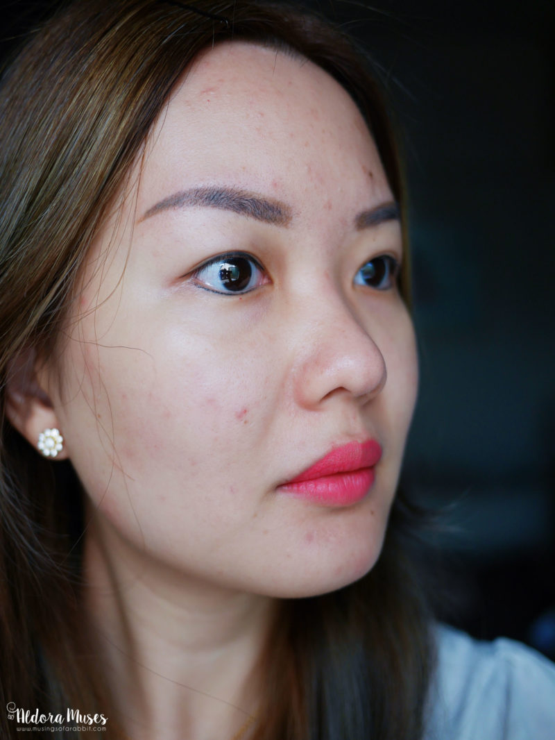 Treat Adult Acne with The Clifford Clinic